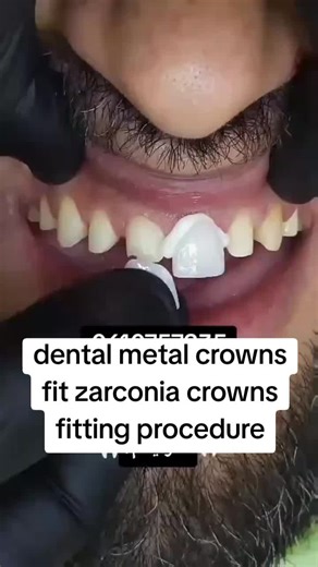 Understanding Dental Crowns: Fitting Procedures and Options