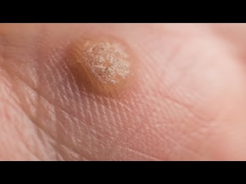 how to get rid of warts on fingers in a day