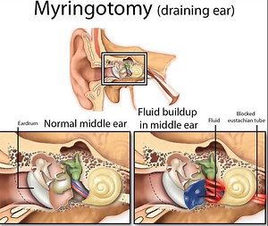 Myringotomy procedure, myringotomy tubes placement, risks & recovery