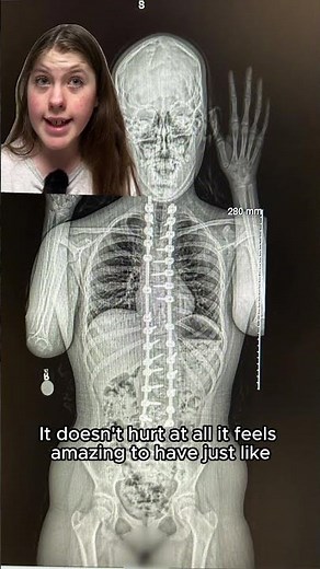 Back in the Saddle After Scoliosis Surgery | Paley Institute