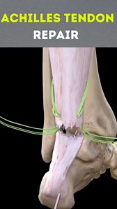 A cirurgia de ruptura do tendão de Aquiles é realizada para reparar um tendão de Aquiles rompido, que conecta os músculos da panturrilha ao calcanhar. A lesão é comum entre atletas e pode resultar de uma sobrecarga ou movimento súbito. Preparação para a Cirurgia: O paciente é tipicamente submetido a anestesia geral ou regional. A área ao redor do tendão de Aquiles é limpa e preparada para a cirurgia. Incisão: O cirurgião faz uma incisão na parte de trás do tornozelo, sobre o tendão de Aquiles ro