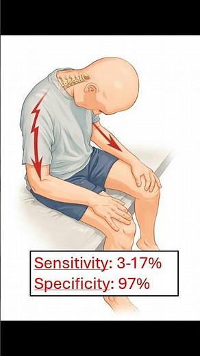 ⚡ Lhermittes Sign Explained | Electric Shock Sensation with Neck Flexion #neurosurgery #spine #meded