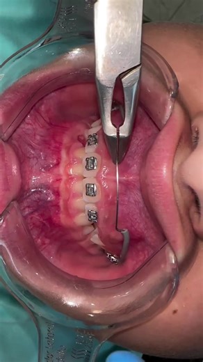 Comprehensive Guide to Orthodontic Treatment Options