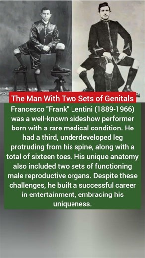 The Man With Three Legs and 16 Toes #shorts