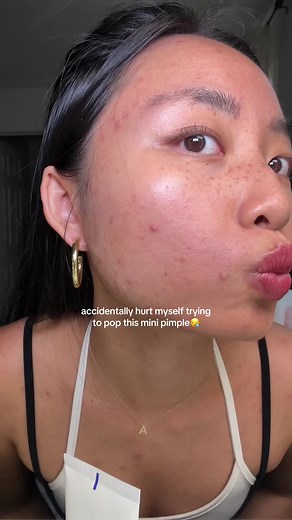 i always get rid of the mini pimples..idk it gives me the ick🥲 #acneproneskin #acnejourney #pimples #acneskin