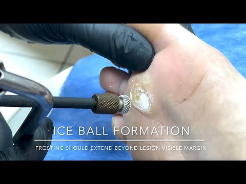 Steps of Cryotherapy (real case)