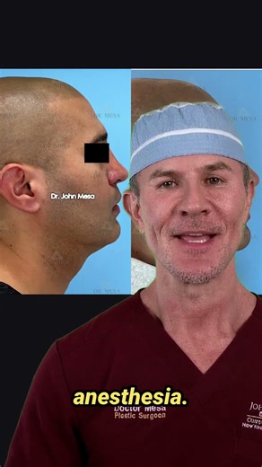 See the transformation after Extended Chin Liposuction! #chinlipo #beforeandafter #plasticsurgery