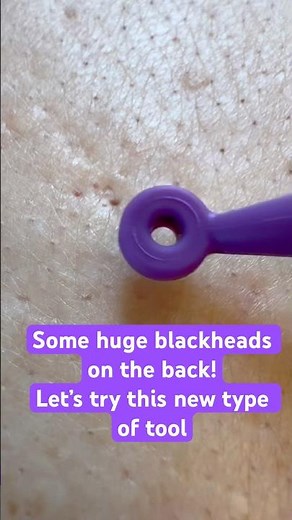 Those blackheads came out so easily and the client barely felt anything! #blackhead #extraction