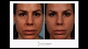 Filler Injections for Facial Volume Loss and Full Results