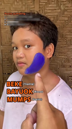 Mumps Awareness: Signs and Symptoms Explained