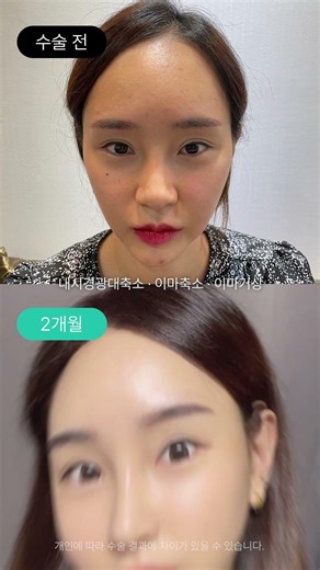 내시경광대축소, 이마거상축소 후 훈녀된 썰✨️ #성형후기 #성형전후