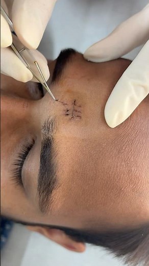 Simple suture removal method | Stitches Removal