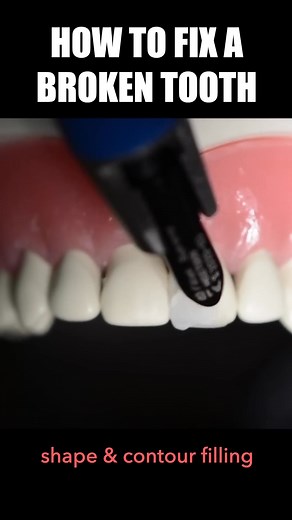 1.9K views · 488 reactions | broken front teeth can be filled with a tooth colored composite filling. if the fracture affects the pulp, then root canal treatment must also be done | City dental clinic Byo | Facebook