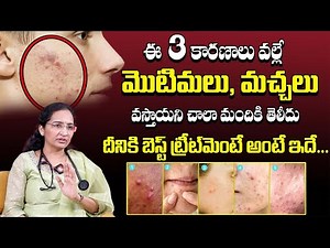How to Get Rid of Comedonal Acne || Blackheads and Whiteheads Removal Treament || Dr. Suhasini