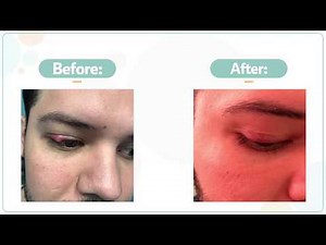 How to treat a chalazion (eyelid lump)