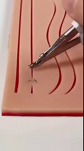 12K views · 270 reactions | To remove staples, place the lower jaw of the remover under a staple. Squeeze the handles completely to close the device. This bends the staple in the middle and pulls the edges out of the skin. Gently move the staple away from the incision site when both ends are visible. Sent by a fan. | Dr.Weird | Facebook