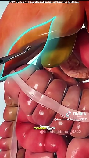How Gallstones Are Formed & Removed Without Surgery | Cholangioscopy Lithotripsy Explained
