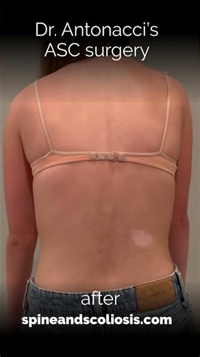 X Rays Before and After Scoliosis Surgery