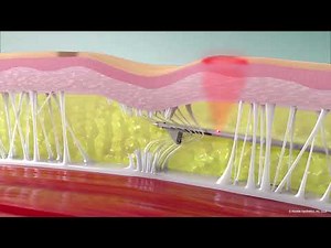 Cellulite Treatment by Aveli