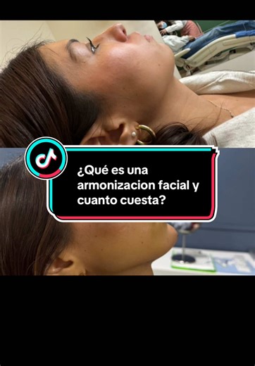 Qué es una armonización facial y cuánto cuesta? Se utiliza de 3 a 5 jeringas en diferentes partes del rostro para dar simetría y armonía. Tiene un costo de $16,500 pesos, no duele, y ayuda a dar simetría y mejorar rasgos que se pueden ir perdiendo con la edad por ejemplo la forma del mentón, y agregar un poco de protección en pómulo. La clave es trabajar de manera sutil para resaltar la belleza sin deformar la carita de los pacientes en darles mucho volumen #armonizacionfacial #acidohialuronico 