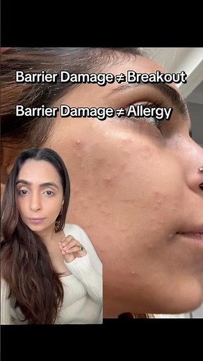 Broken Skin Barrier | Is this breakout or allergy or broken skin barrier? How to tell the difference