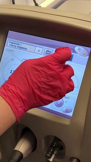 Vbeam Cherry Angiomas | Full Body 2