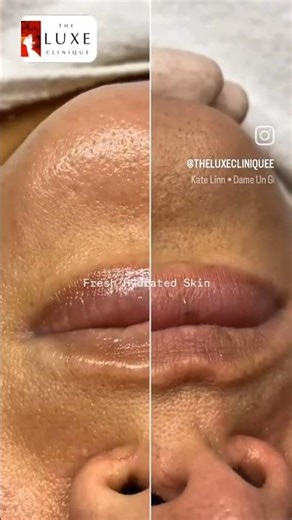 Skin Decongesting Deep cleansing Before After Hydrafacial comedone extraction