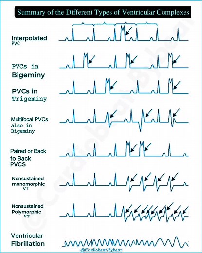 Understanding PVC Patterns in Cardiac Health