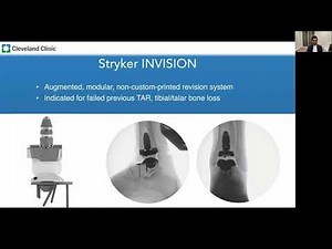 A Comparative Analysis of Outcomes in Total Ankle Replacement