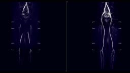Bandingkan angiografi resonansi magnetik atau MRA dari aorta, iliaka,...
