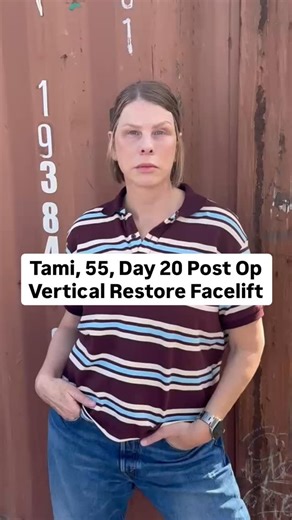 Amir M Karam, MD on Instagram: "Tami checking in at Day 20 post op and doing great. She’s back home in Las Vegas, still a little swollen as expected, but healing beautifully and staying in great spirits. Since it’s Christmas Eve, we had to share this update. Tami always keeps us smiling. If you’re new here, be sure to go back and watch her Day 1 and Week 1 check ins to catch up on her journey so far. More updates coming soon. Happy holidays from Tami and our entire team. So much more to come! An