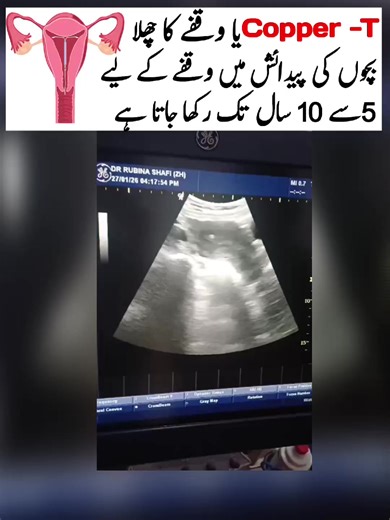 Understanding Copper T for Family Planning