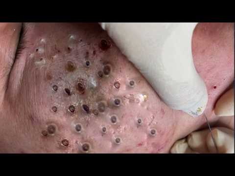 Extreme Blackhead Extraction & Cystic Acne Removal | Satisfying ASMR