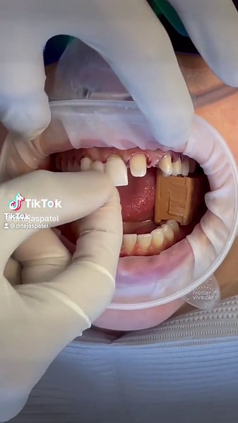 How to Put on Veneers and Bridges: A Complete Guide