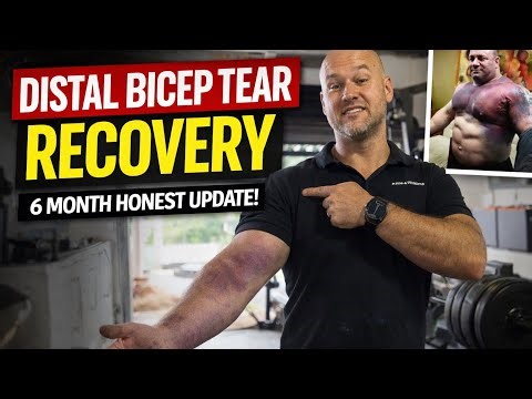 Distal Bicep Tear Recovery Update – 6 Months Later (Strength, Pain & What They Don’t Tell You)