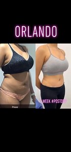 Tummy Tuck Journey