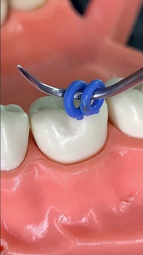 🔥Orthodontic Elastic Separators / Dental Spacers Orthodontic🔥
