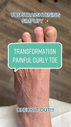 𝚃𝙾𝙴 𝚂𝚝𝚛𝚊𝚒𝚐𝚑𝚝𝚎𝚗𝚒𝚗𝚐 𝚜𝚒𝚖𝚙𝚕𝚒𝚏𝚢 ✨ ✨ Before and After results ✨with less than 2mm incision to transform this painful hammertoe deformity. This done through minimally invasive techniques involves with NO pins, NO screws, NO stitches and ONLY local anesthesia, walking on the same day, and operated in office surgical suite. If you or you know anyone ready to be our next foot transformation? ❣️ 💬Comment below! ⬇️ #ingrowntoenail #bunions #stifftoe #toeshortening #hammertoes #cross