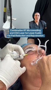 Combination RF Microneedling and CO2 Laser for Lower Eyelid Fat Pad Reduction and Rejuvenation The aging eyelids are characterized by skin laxity, crepey or thin skin, and fat pads, which give a bulgy appearance to the lower eyelids. A great way to reduce these signs of aging is through a combination of radiofrequency microneedling and CO2 laser. Watch this video to see how this combination technique can take years off of the aging eyelids and upper lip in a matter of minutes. Pain Level: 0 afte