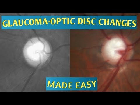 OPTIC DISC EVALUATION|CUP DISC RATIO| DEPTH OF CUP| BAYONETTING SIGN||LAMELLAR DOT SIGN| RNFL DEFECT