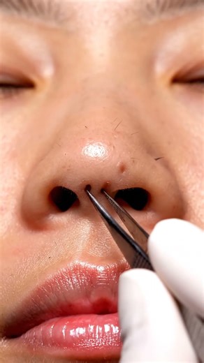 🤯 GIANT Blackhead EXTRACTION! 😱 You Won't Believe What Comes Out! #blackheads #pimplepop