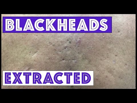 Were these blackheads & cysts from Agent Orange exposure?