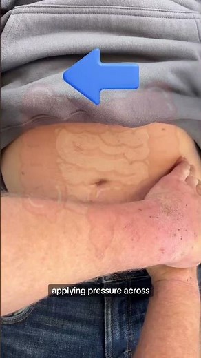 How to Assess for Appendicitis: Rovsing's Sign #abdominalpain