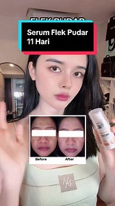 Serum Flek dengan Cysteamine 10% dan Niacinamide 10% – Hasil dalam 11 Hari