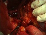 Vídeo de esplenectomía • Vídeo • MEDtube.es