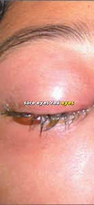 #barbaraoneill - Potato poultice | Health Tips Tricks