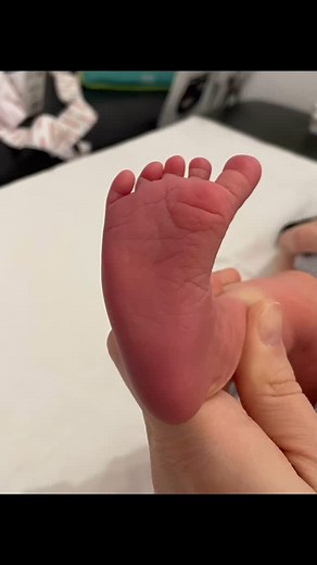 Un petit pied metatarsus varus qui va nécessiter la pose de plaquette. Pour corriger spécifiquement le bord externe, le bord interne, et réaligner l’avant pied avec le bloc calcaneo pédieux. Dès la naissance, 5 jours de vie pour une meilleure efficacité 🦶🏼 #kine #baby #physio #pediatrie #bebe | Kiné des bébés