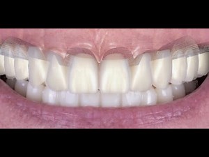 How to Design a Ivotion denture in Exocad