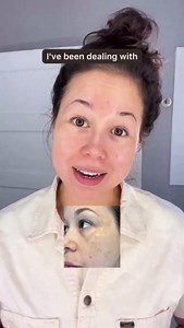 After two and a half months on The Spot Cream and The Spot Pill, Canyon regained confidence in her bare skin! The Spot Pill treats stubborn melasma from within, while The Spot Cream works on the surface to fade dark spots, sun damage, acne scars, and age spots 💫 Pair them together to boost your results! | Musely