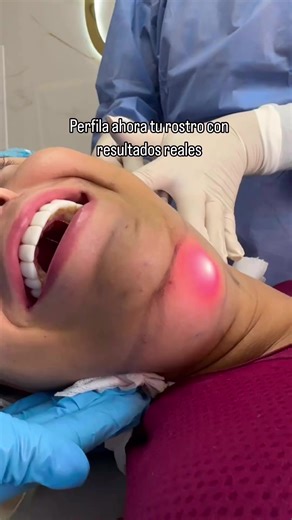 Transforma Tu Papada con Lipomarcación Láser